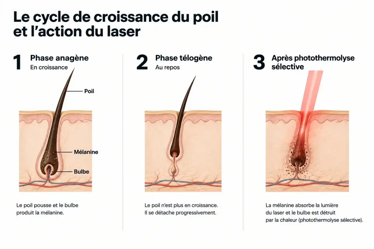 Schéma du cycle de croissance du poil et de l'action de l'épilation laser chez 129 Center